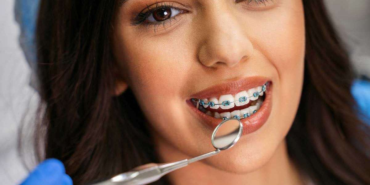 Teeth Braces Cost Guide for Families with Multiple Children
