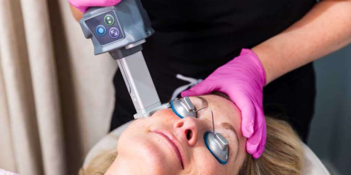 Fractional CO2 Laser Treatment for Wrinkle Reduction